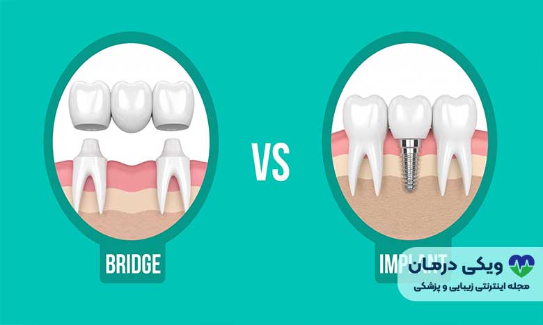 تفاوت بین ایمپلنت یا بریج چیست؟