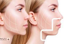 عمل زاویه سازی فک و صورت