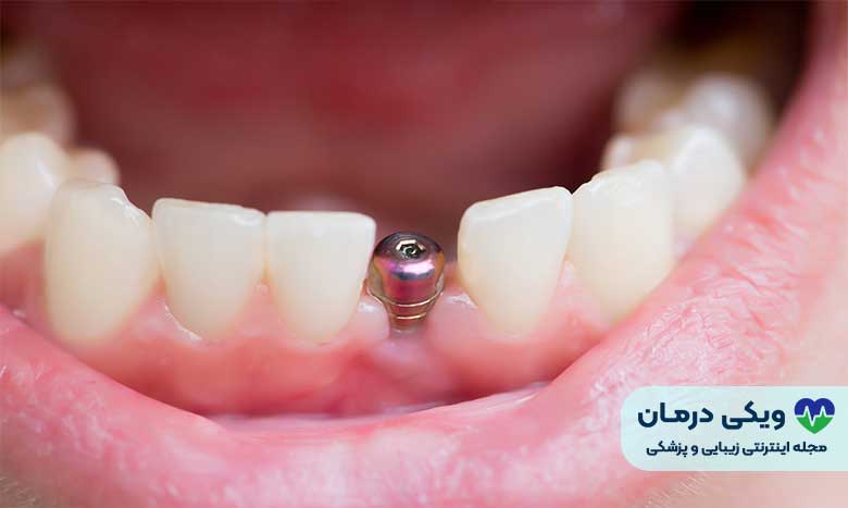 مزیت‌های ایمپلنت دندان جلو