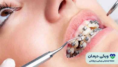 هزینه ارتودنسی با بیمه