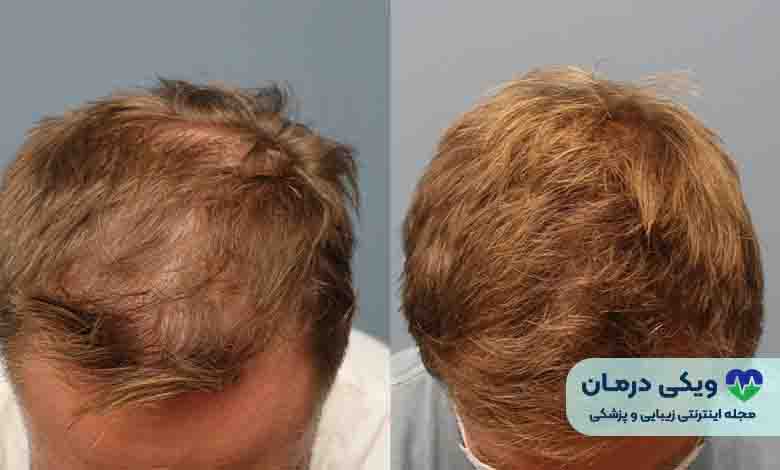 کاشت مو به روش SUT