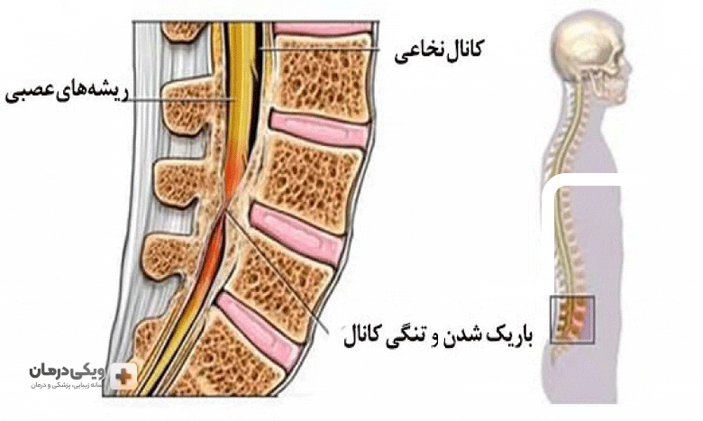 تنگی کانال
