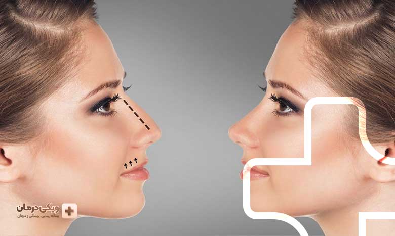 معرفی بهترین جراح بینی استخوانی