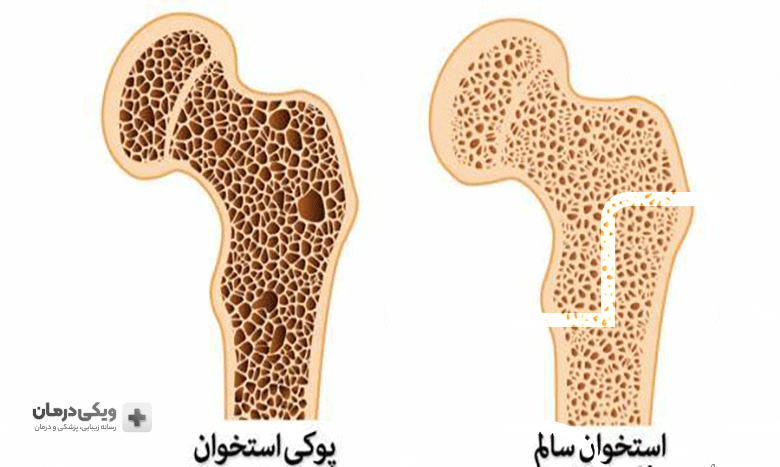 پوکی استخوان