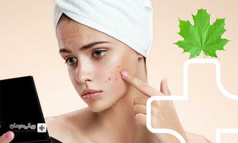 چه چیزی باعث آکنه می‌شود؟