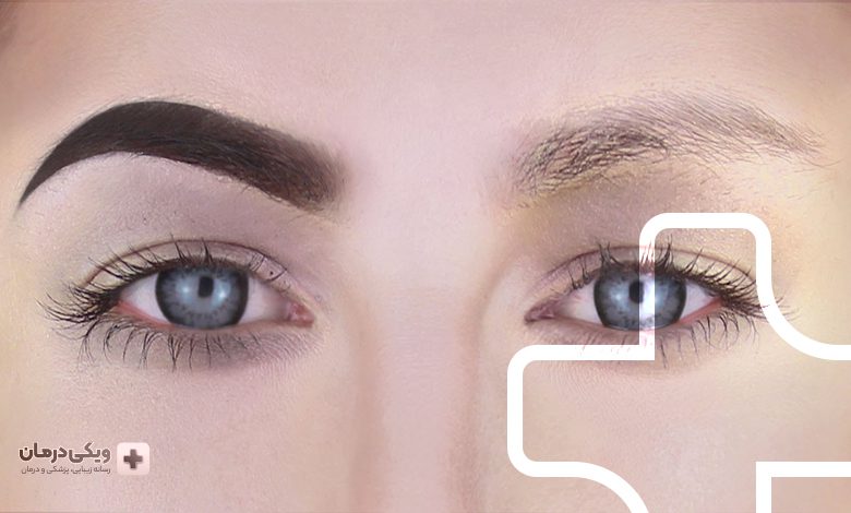 ویژگی های بهترین دکتر کاشت ابرو