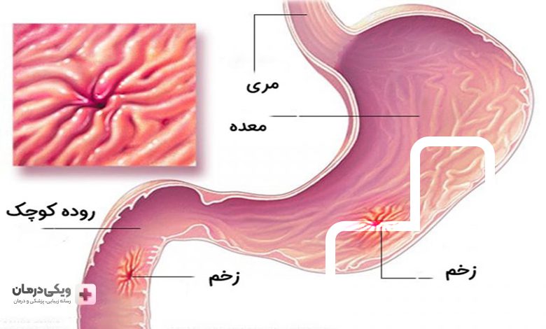 معرفی بهترین دکتر زخم معده