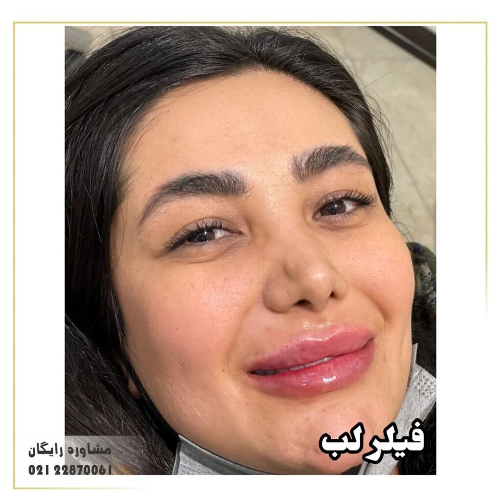 فیلر لب