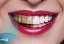 بهترین دکتر کامپوزیت