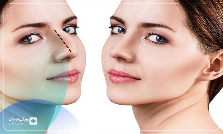 بهترین جراح بینی استخوانی