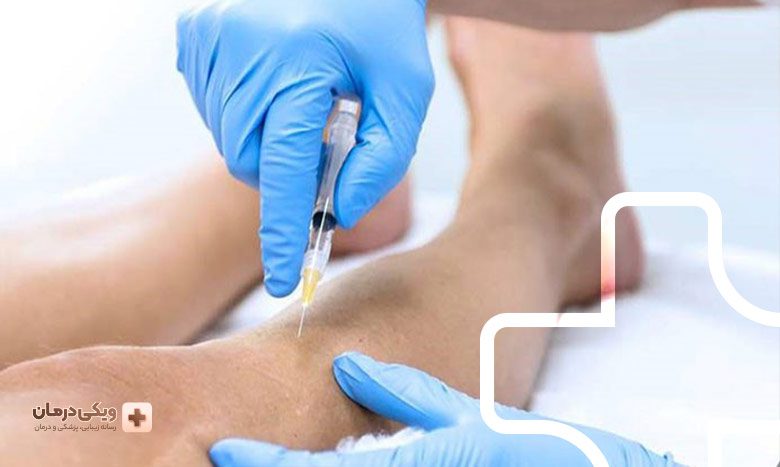 مزایای اسکلروتراپی