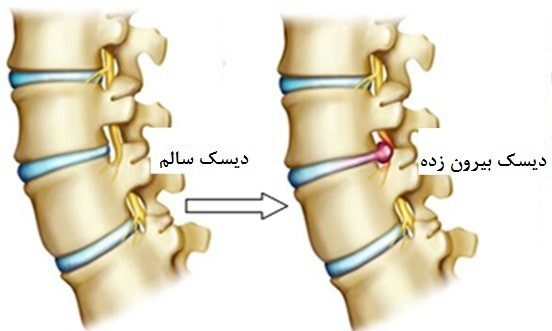 دیسک کمر