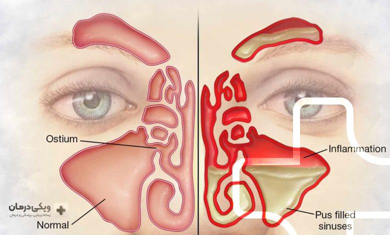 سینوزیت چیست؟