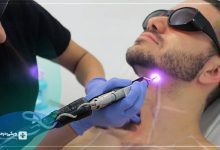 لیزر مو در عظیمیه