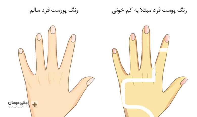 نشانه-های-کم-خونی