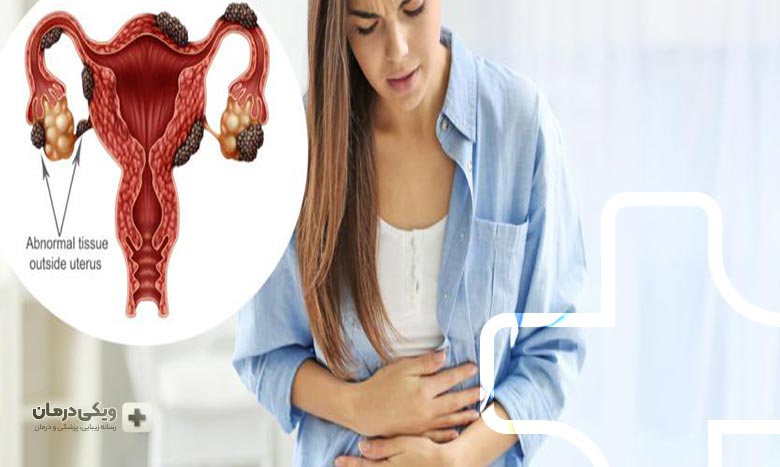 آندومتریوز چیست؟