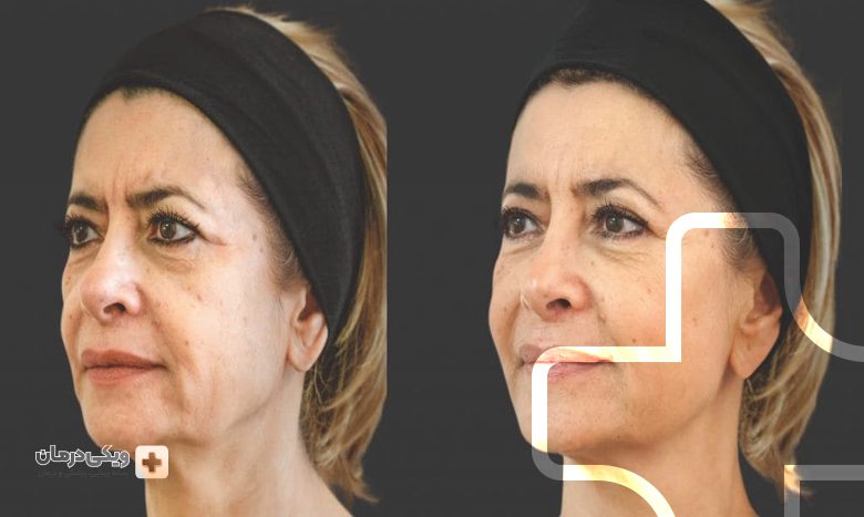 ژل الانسه