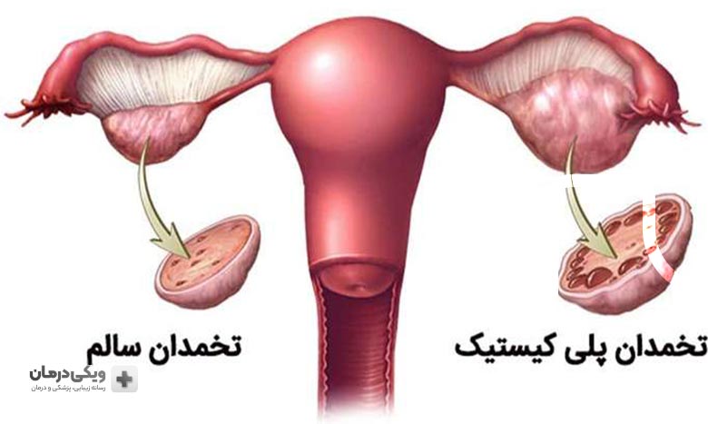 علائم سندروم پلی کیستیک تخمدان یا تنبلی تخمدان (PCO)