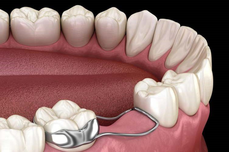استفاده از فضا نگهدارنده توسط دندانپزشکی اطفال