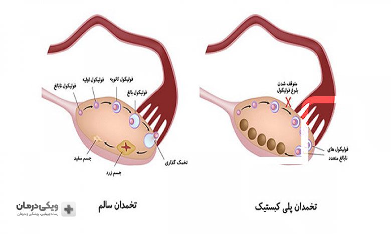 علل ایجاد سندروم تخمدان