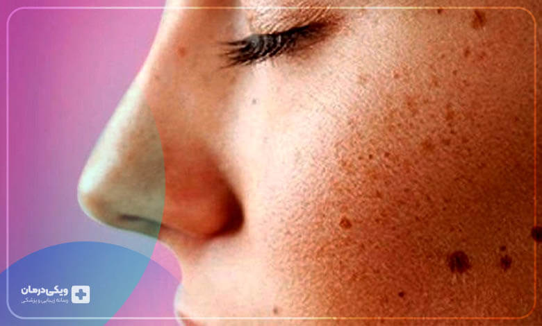 ضایعات رنگی پوست
