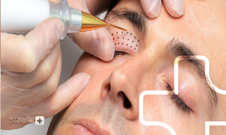 عوارض پلاسماجت چیست؟