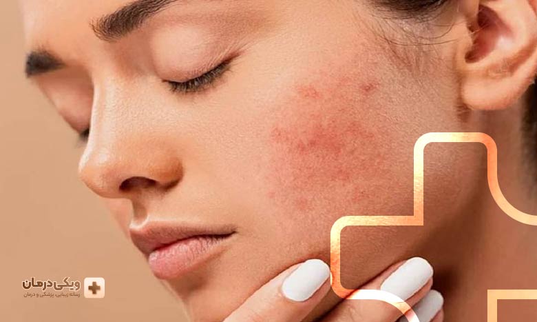 دلایل ایجاد جای زخم
