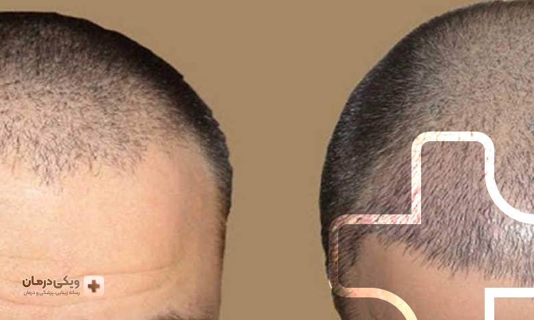 هزینه کاشت مو به روش سلول های بنیادی