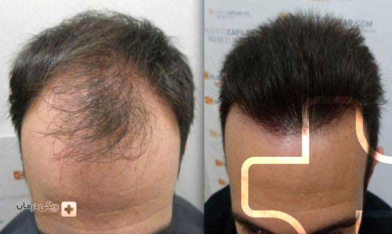 مزایا و معایب کاشت مو به روش سلول های بنیادی