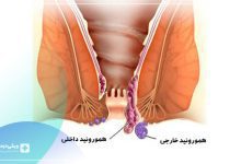 هموروئید خارجی