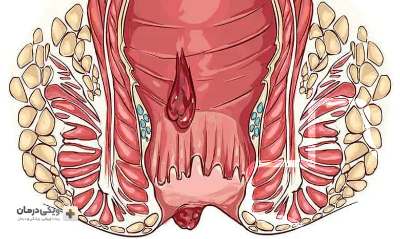 دلایل ایجاد هموروئید ترومبوزه