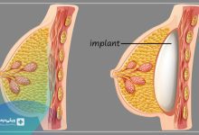 بیماری ماستیت - عفونت پستان