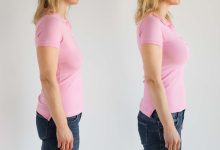 جراحی پروتزپکسی