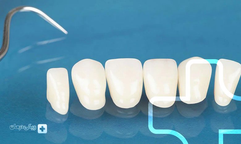 عمر لمینت سرامیکی چقدر است؟