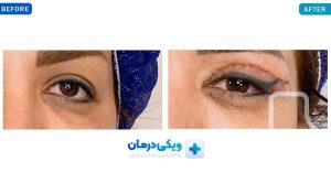 نمونه کار بلفاروپلاستی کلینیک زیبایی شادابی