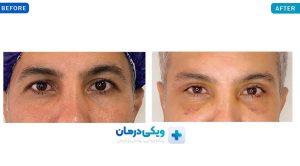 عکس قبل و بعد بلفارو در کلینیک شادابی
