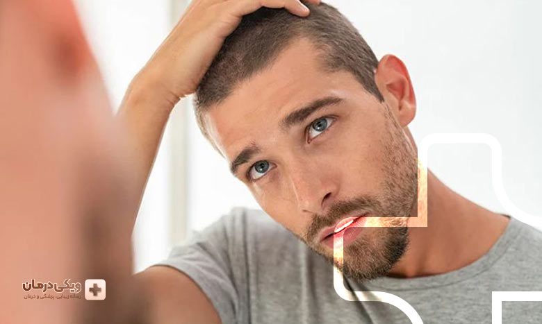 مزایای کاشت مو به روش sht چیست؟