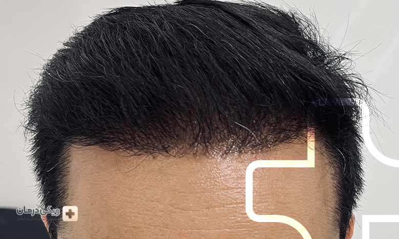 کاشت مو به روش FIT