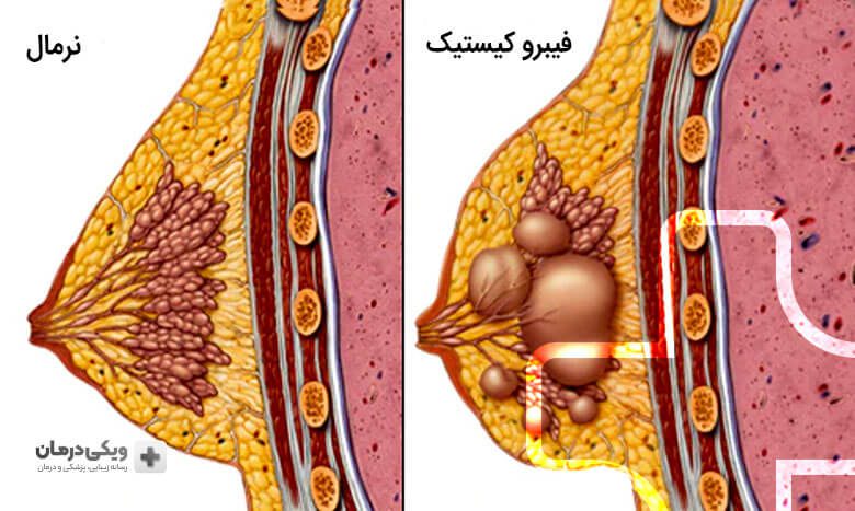 انواع کیست سینه
