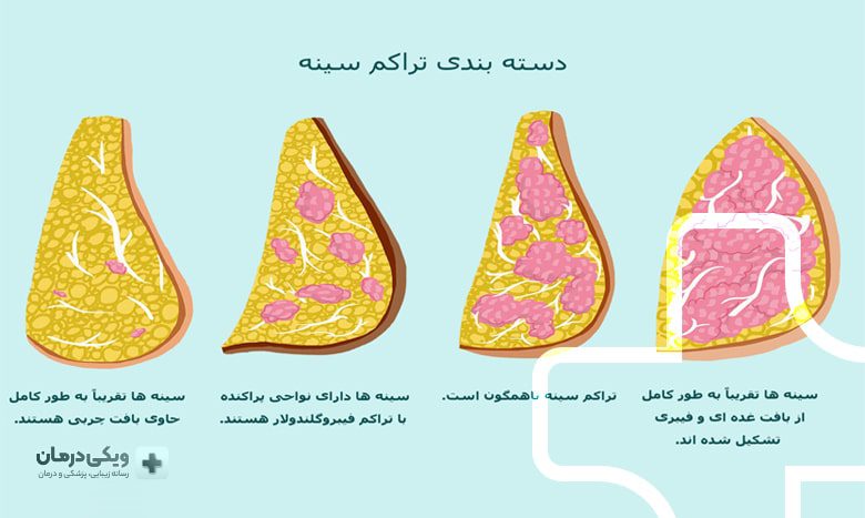 بافت سینه متراکم
