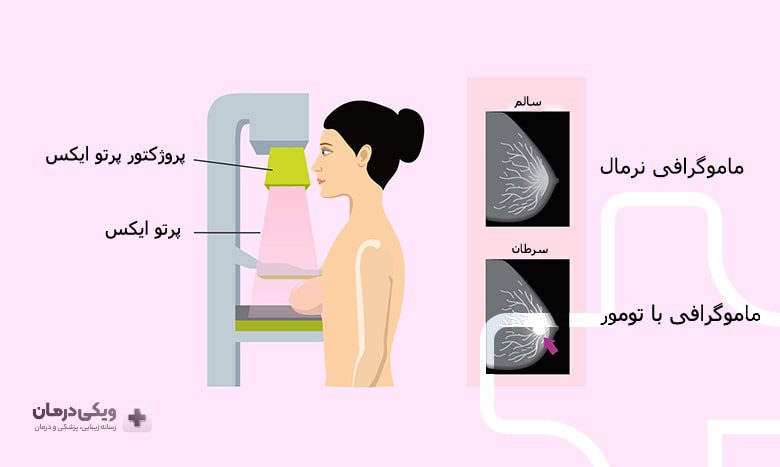 آزمایش بافت تراکم سینه چگونه است؟