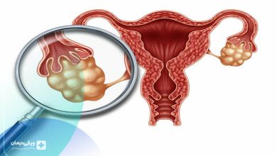 شانس باردار شدن با تخمدان پلی کیستیک چگونه است؟