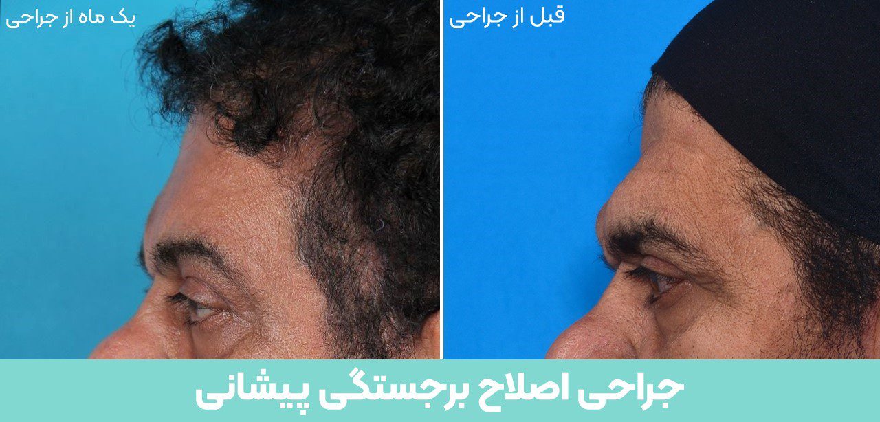 اصلاح پیشانی برجسته یا نئادرتال