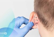 بهترین جراح زیبایی گوش