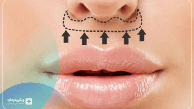 انواع روش‌های لیفت سانترال لب