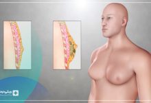 ژنیکوماستی یا بزرگ شدن سینه در مردان چیست؟