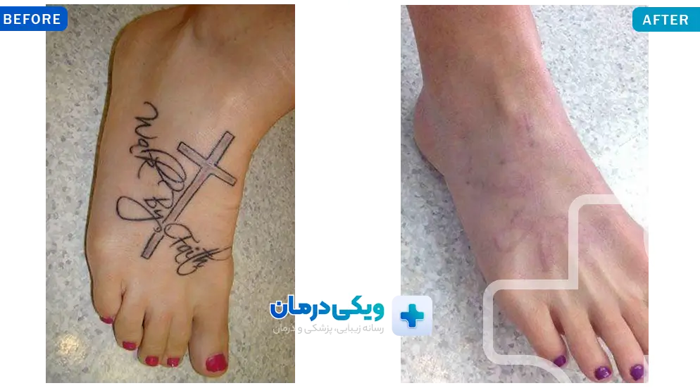 نمونه پاک کردن تاتو با لیزر