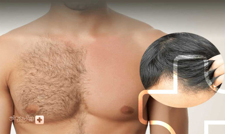 بهترین نواحی برای کاشت مو 
