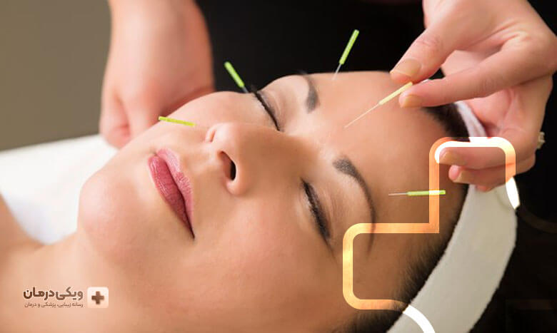 فیشیال طب سوزنی