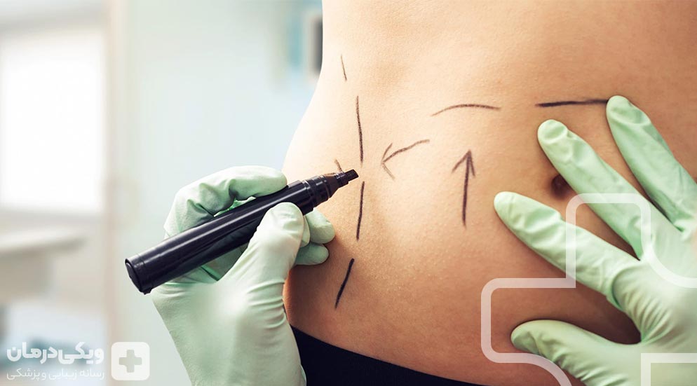 Lipomatic surgery